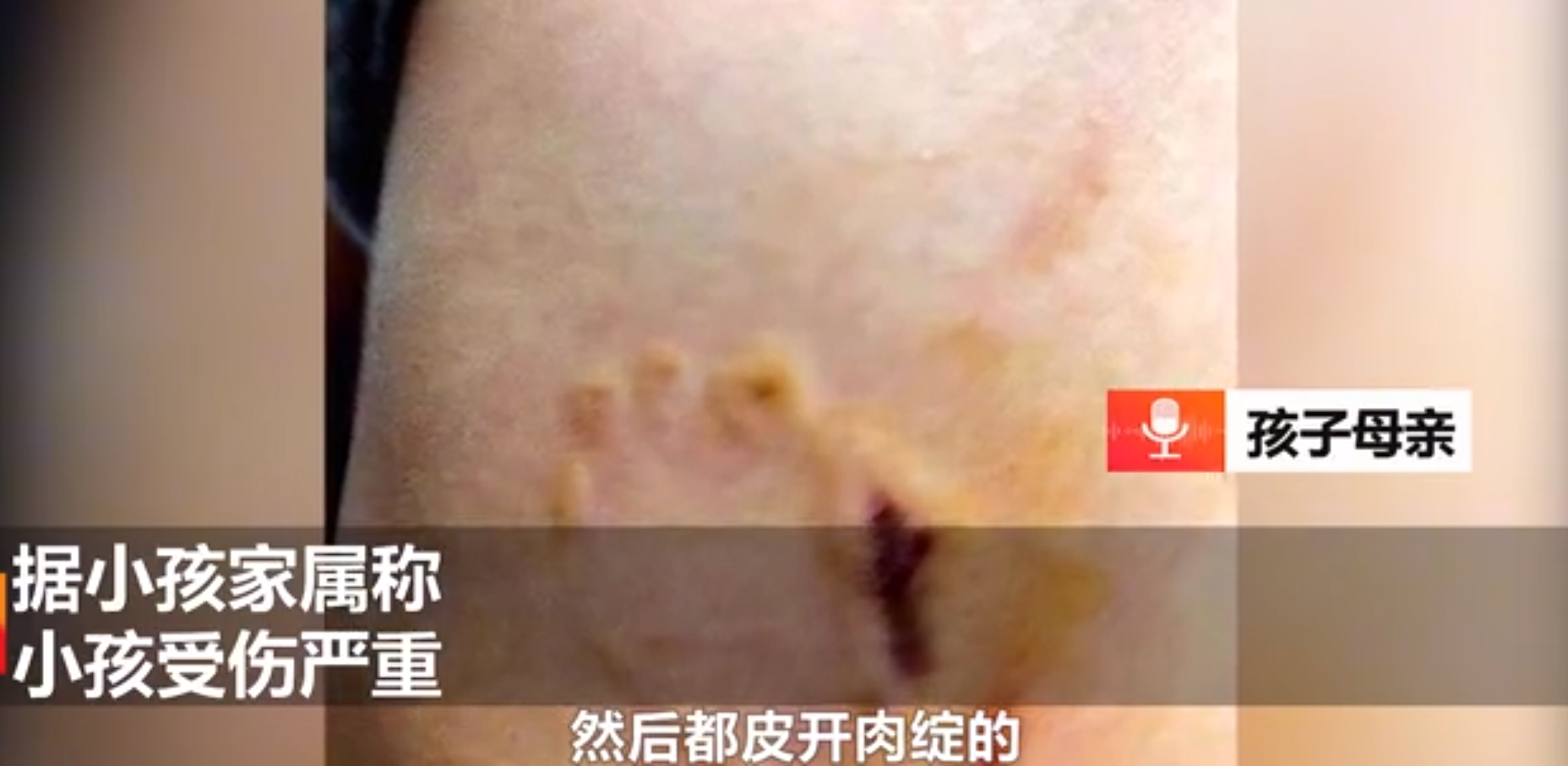武汉6岁男童被烈性犬咬伤，狗主人态度嚣张不承认：我家狗不咬人